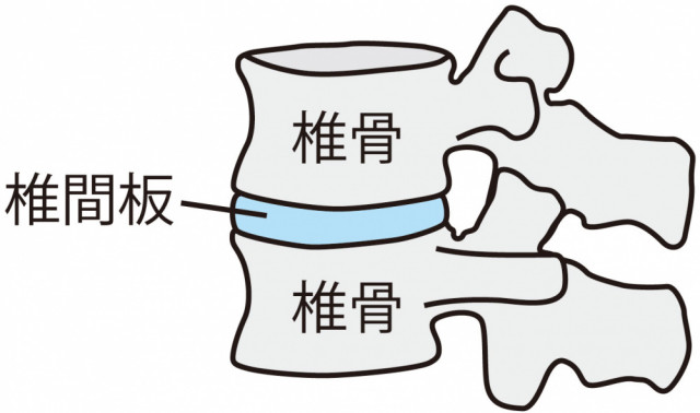 腰椎椎間板ヘルニアとは