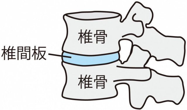 ヘルニアとはそもそもどんなことを言うの?