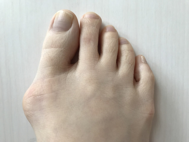 外反母趾とは?